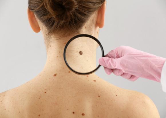 Pasirūpinkite savo odos sveikata - pasitikrinkite dėl melanomos